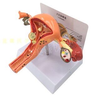 人体模型女性生殖子宫模型阴道卵巢模型教学模具病理变化科普教具