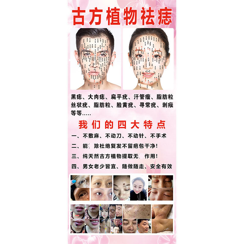 古方祛疣男女面痣图去痣祛斑祛痘