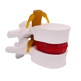 人体脊柱模型脊椎骨头腰椎间盘模具椎体模型突出受压病理骨质教具