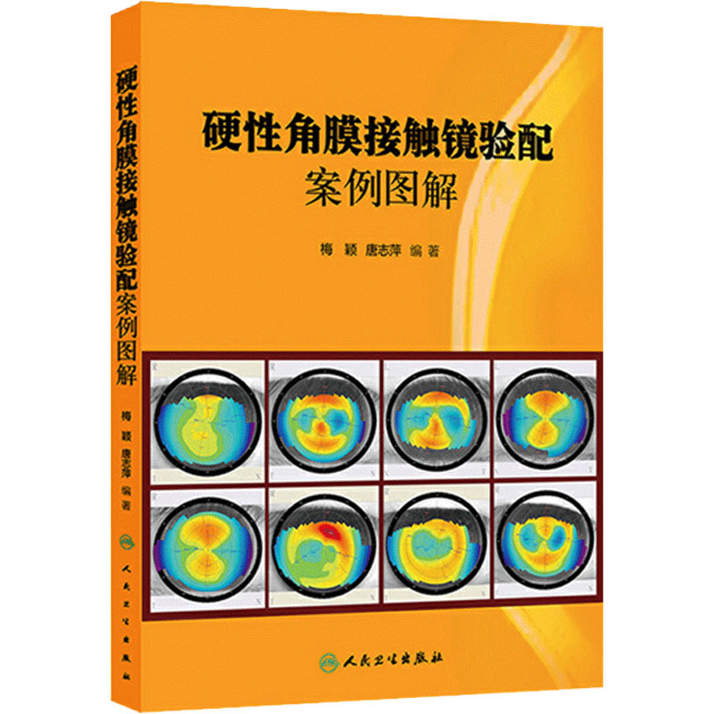 硬性角膜接触镜验配案例图解