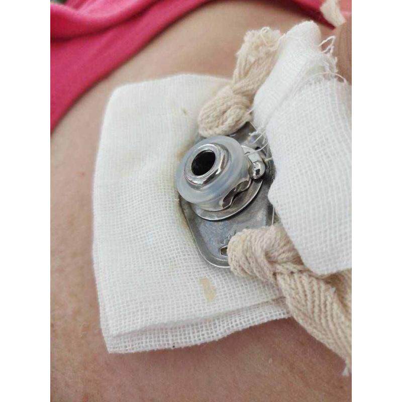 金属气管套管转接头呼吸机转接头气切套管接人工鼻说话瓣膜