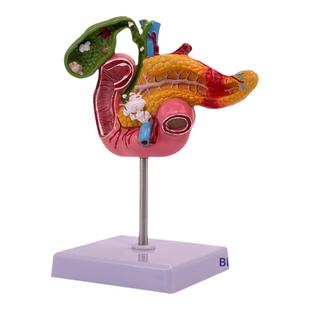 教学仿真人体胰腺十二指肠胆囊病理模型 胆结石外科消化系统教具
