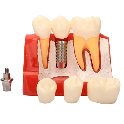 牙齿模型 牙科种植六倍大龋齿病理修复正畸 假牙口腔医院教学摆件