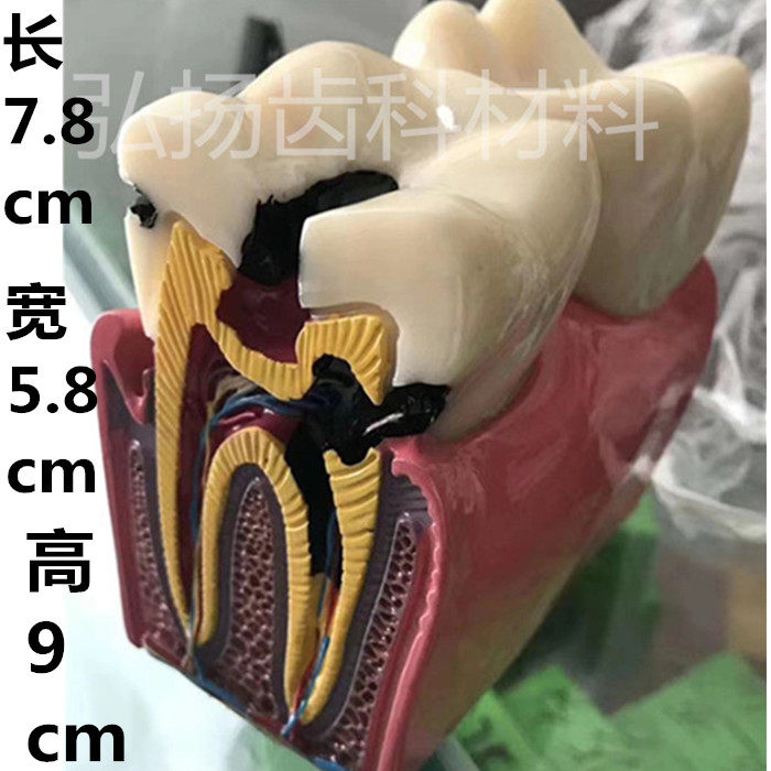 牙科口腔模型 解剖放大蛀牙模具医患沟通六倍牙齿龋坏病理演示