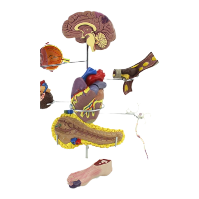 诺人体医学糖尿病危害模型