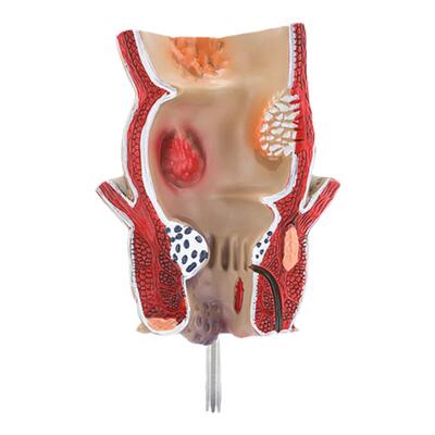 蓝蝶模型直肠痔疮病变教具