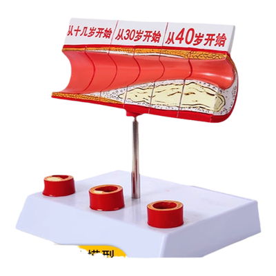 人体血管结构病变演示模型