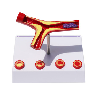 血管堵塞动支脉粥样硬化心血管模型病理动态血管血栓流动对比模型