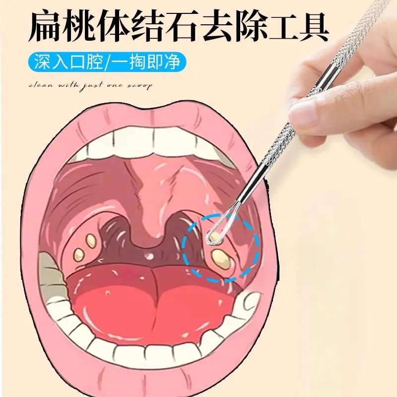 扁桃体结石去除工具取出隐窝神器口腔扁条体扁桃腺扁导体石清理器