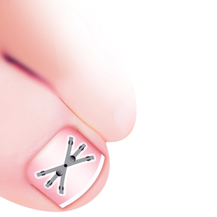 赤坂甲沟嵌甲炎矫正器正甲贴指甲内嵌纠正贴脚趾指甲往肉里长专用