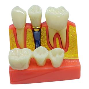 牙模型可拆卸刷牙龋齿种植病理牙列水晶头颅备牙练习磨具教具教学