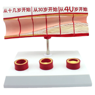 ENOVO颐诺人体血脂总胆固醇与年龄关系模型冠心病心血管胆固醇代谢健康宣传教学演示心脏模型心内科医患沟通