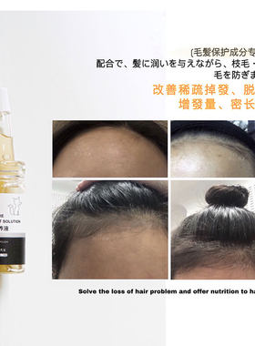 秃头小宝贝看过来！美小狐护发营养液稀疏发际线浓密生长发防掉发