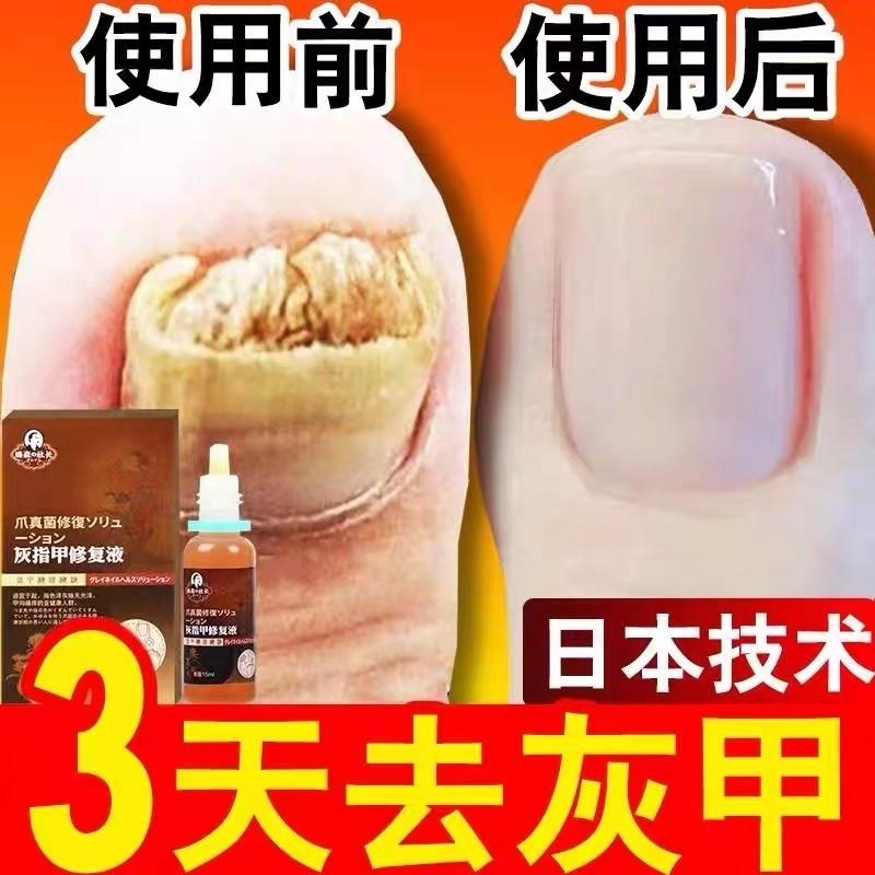 灰指甲专用药治疗特效根治买2送1