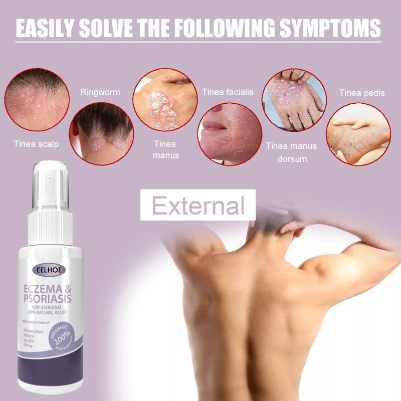 EELHOE Skin Psoriasis Spray Dermatitis Eczematoid Eczema Oin