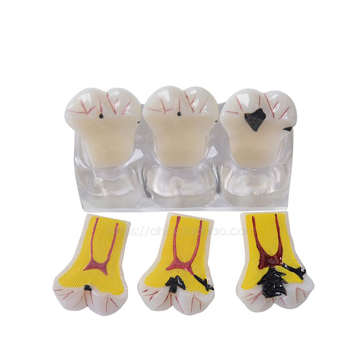 牙科模型四倍龋齿演变模型蛀牙演示医患沟通龋齿发展病理分解模型