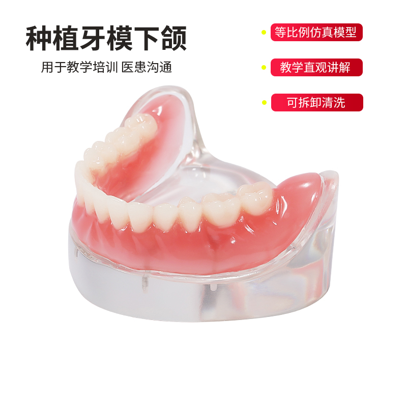 牙科下颌义齿4颗钉种植牙模