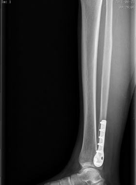 DICOM数字X光机工作站软件图文报告接收胶片打印刻盘mini pacs
