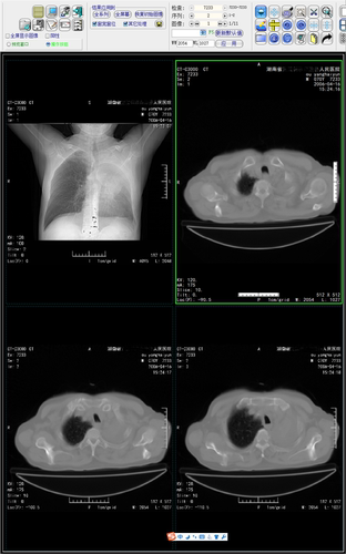 医学dr报告工作站软件刻盘打印