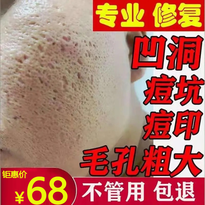 祛痘印痘坑凹洞修复男女士去痘疤淡化膏填充微针消水逗豆再生神器