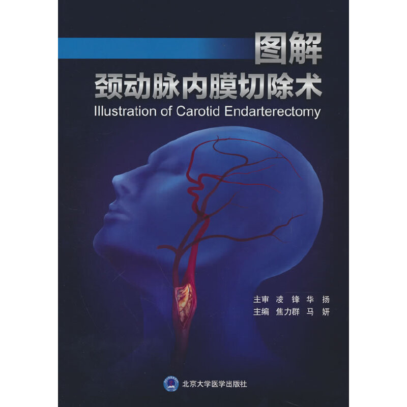 图解颈动脉内膜切除术（宣武医院脑缺血治疗系列丛书）