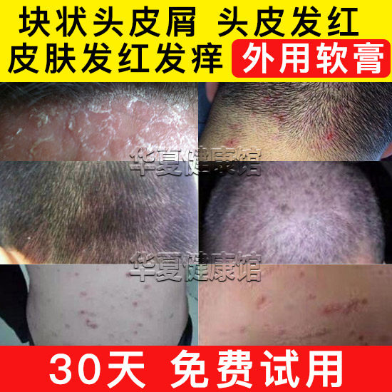 大块头皮屑老偏方黑豆馏油软膏