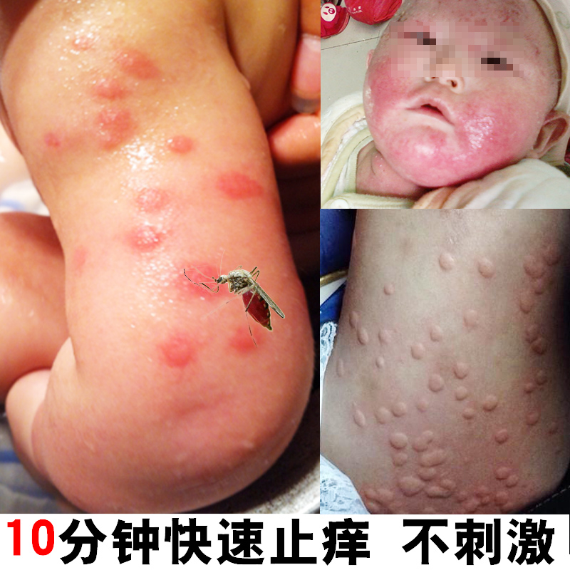 瑞舒琼婴儿蚊虫叮咬止痒消肿膏宝宝溼疹霜成人皮肤瘙痒抑菌止痒