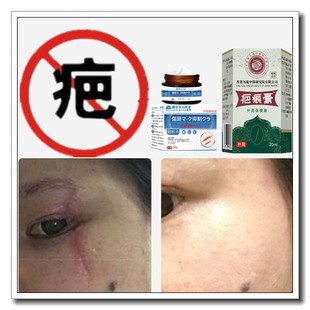 祛增生性疙瘩体质凸疤缝针产后护理开伤疤痕印灵消除去手术正品药