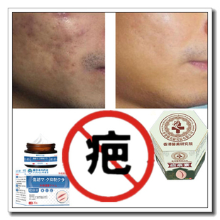 防过敏液正品消除去色素手术产后开伤疤痕印灵修复液软化祛增生药