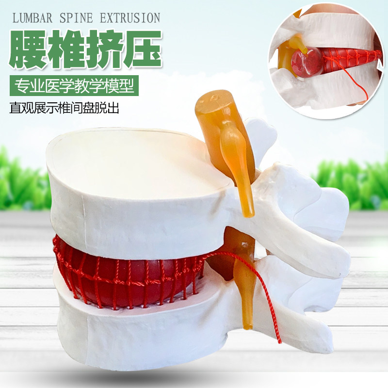 腰椎放大腰椎间盘受压演示模型人体脊柱脊椎骨病理演示关节医学用