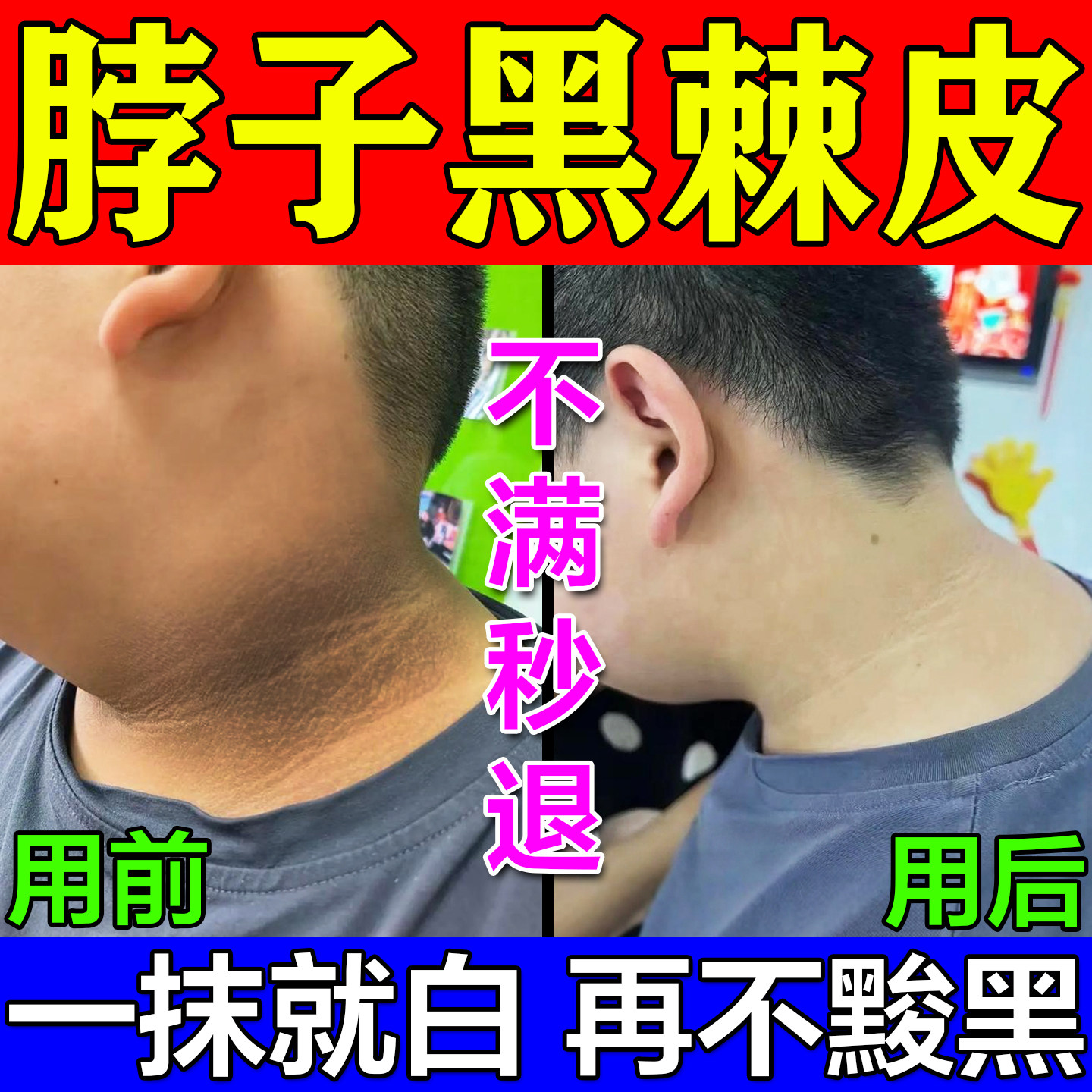 去脖子黑棘皮药膏神器后