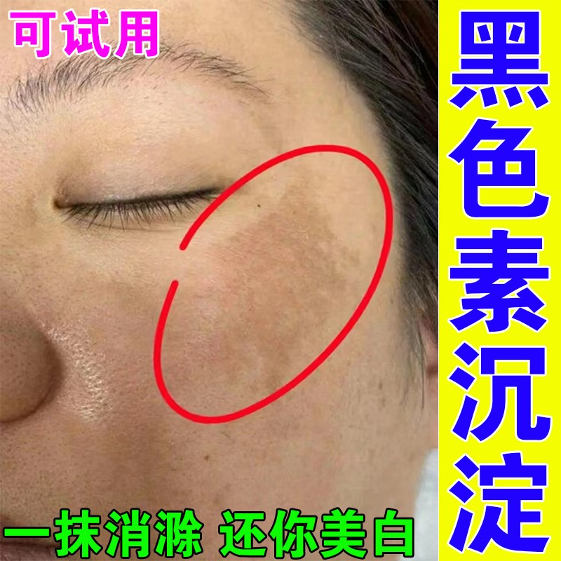 脸上黑色素去除美沉淀祛白斑精华液分解黑色素淡化色斑黄褐专用霜