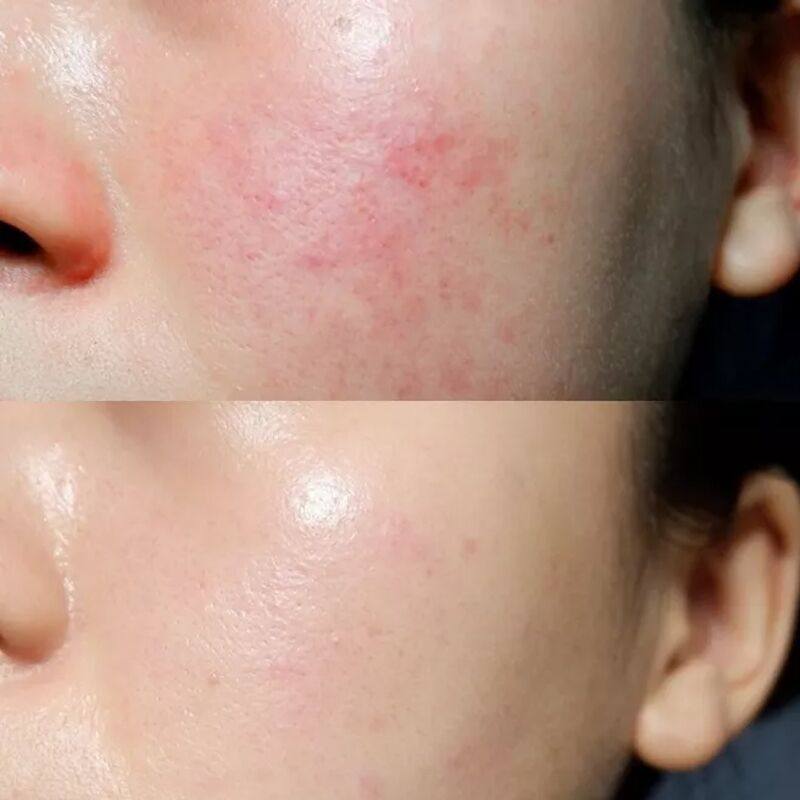 【小红书达人推荐】面部护理面膜 不要脸红高原红 告别红血丝~