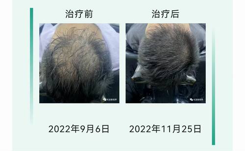 微针护理包