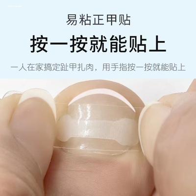 甲沟矫正器指甲矫正嵌甲神器纠正器脚趾甲贴片卷曲甲专用正甲扣炎