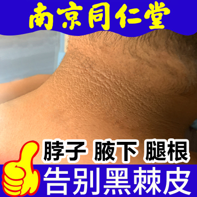 脖子黑黑的黑棘皮症去除