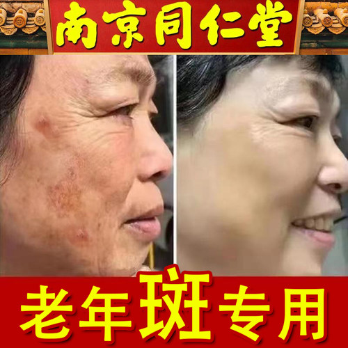 同仁堂祛斑霜正品强力去除老年斑