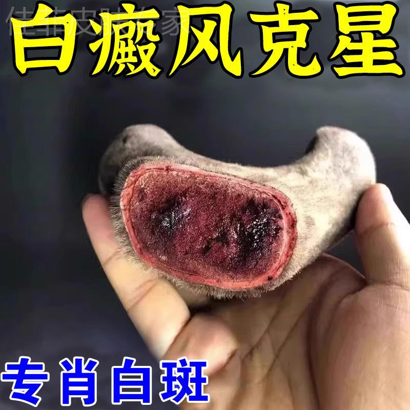 【一抹祛白斑】白癜风外用药膏黑色素生长药快速消白斑除裉特效药