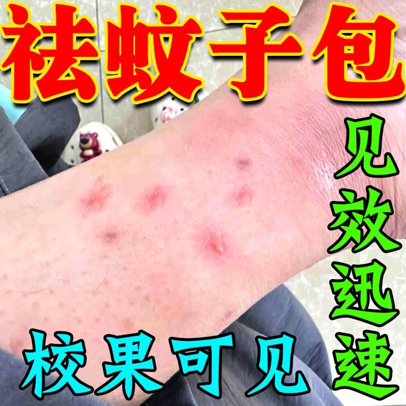 蚊虫叮咬快速止痒肖肿药膏治婴儿宝宝成人臭虫跳蚤蚊子去黑印神器
