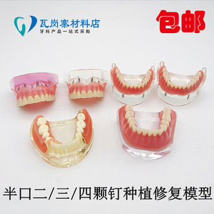牙科 种植修复对比模型 2颗钉3颗钉 4颗钉金轩卡钉义齿修复模型