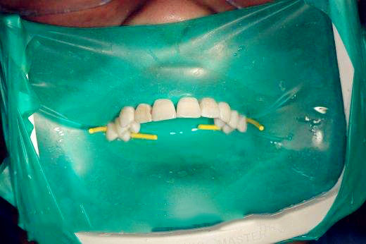 牙科口腔橡皮章楔线 固定软楔线 楔子 嵌塞线 可高温 2.1m  包邮