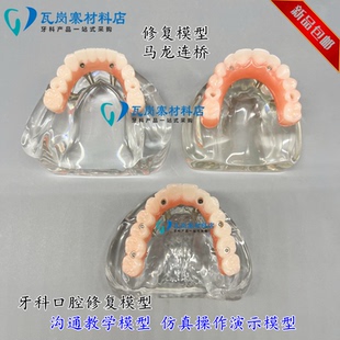 牙科口腔模型馬龍連橋義齒修復(fù)種植牙齒仿真演示模擬教學(xué)醫(yī)患溝通