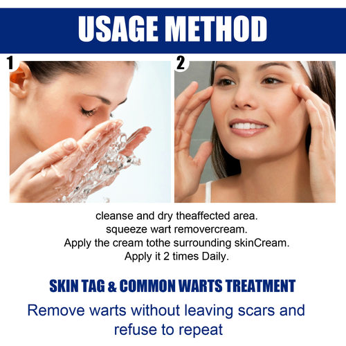 Skin Tag Removal Cream Remove Corns Warts Wart Flat Removal
