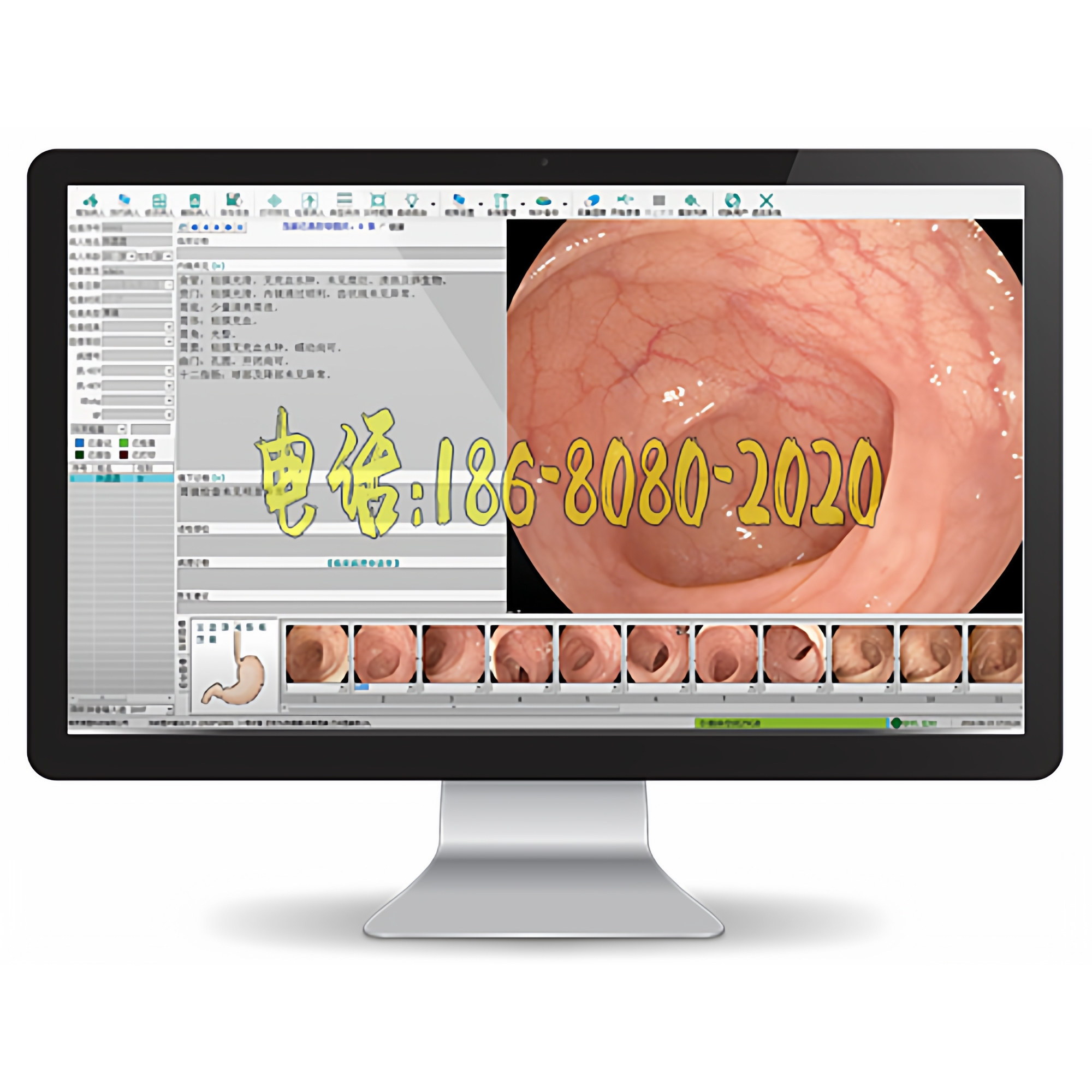 高清HDMI胃肠镜工作站DVI高清内镜高清采集卡连接线脚踏开关全套