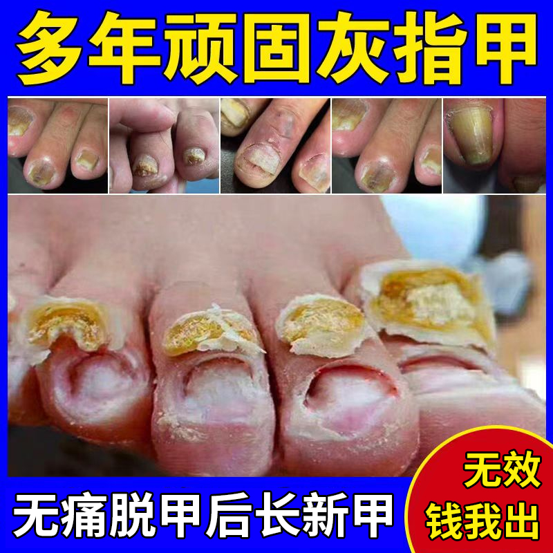 灰指甲无痛脱甲膏甲沟炎脱甲精油