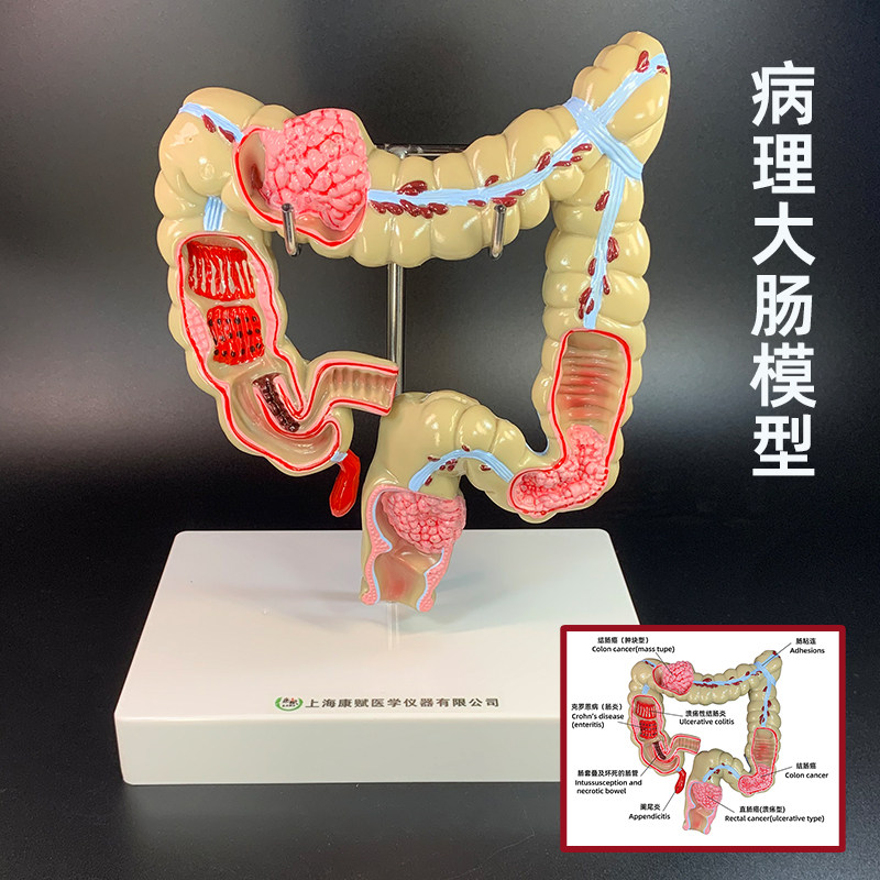大肠病理模型直肠模型肠胃病变解剖模型肠道疾病人体结肠病变模型 - 实物图