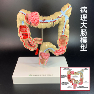 大肠病理模型直肠模型肠胃病变解剖模型肠道疾病人体结肠病变模型