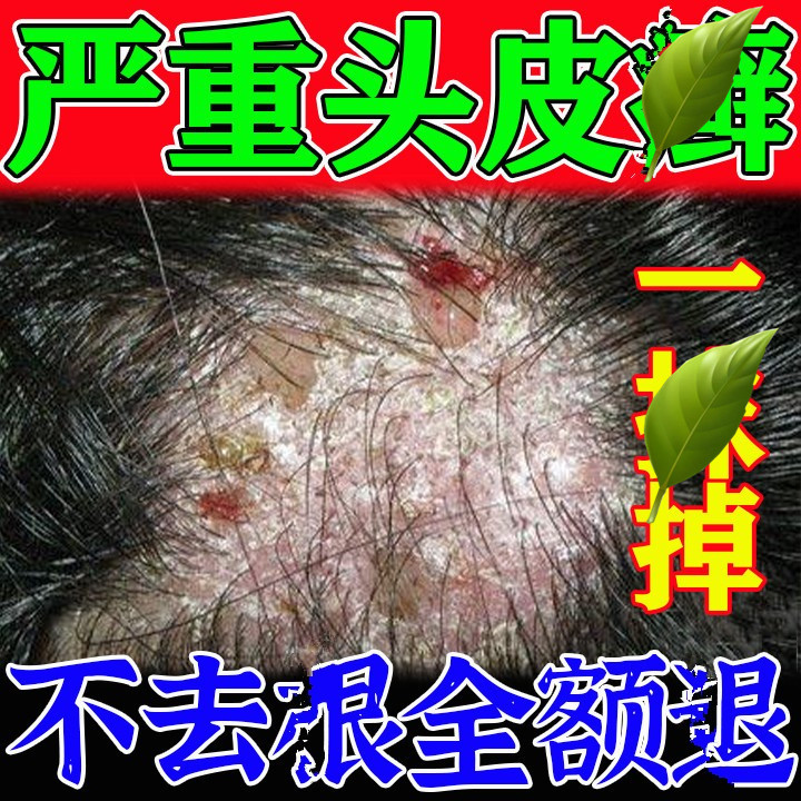 头皮癣银屑病专用药膏真菌感染治疗头部牛皮癣外用去头癣藓特效药