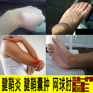 腱鞘囊肿专用膏手腕大拇指腱鞘炎膏药舒筋贴鼓包痛舒贴网球肘治疗