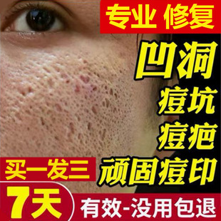 痘印痘坑痘疤凹洞修复填充再生男女士收缩毛孔淡化去痘印膏正品